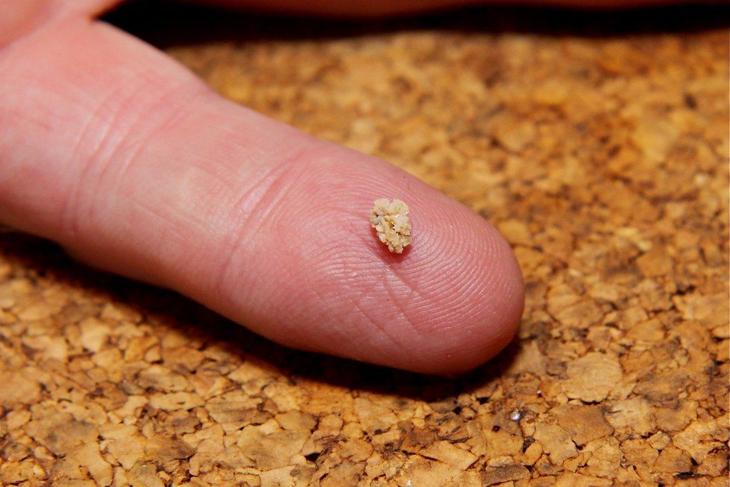 human-study-proves-kidney-stones-can-be-broken-up-by-sound-waves-newscop