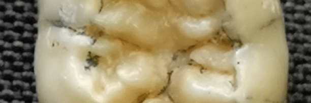 Denisovan tooth