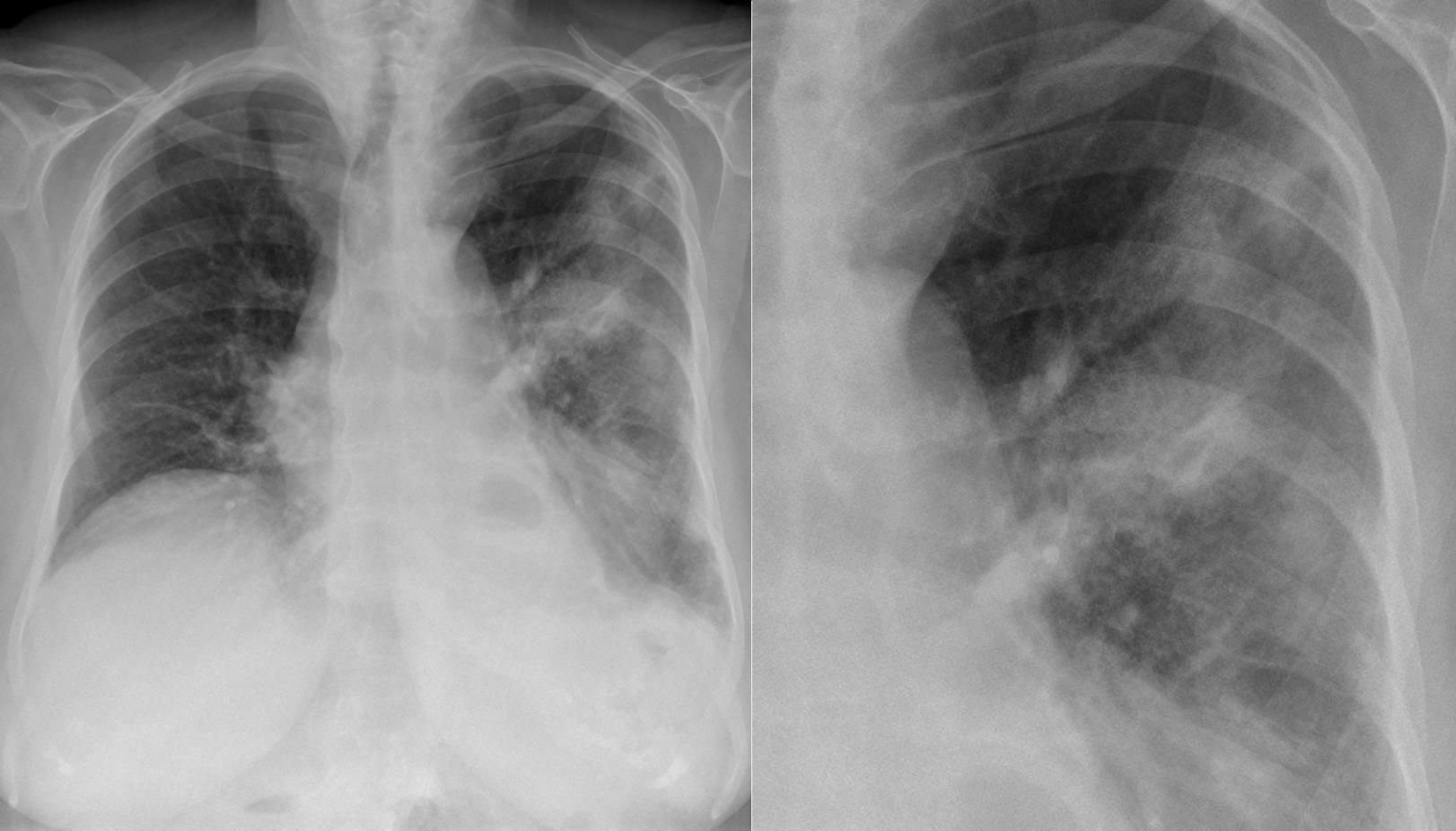 Legionnaires' Disease