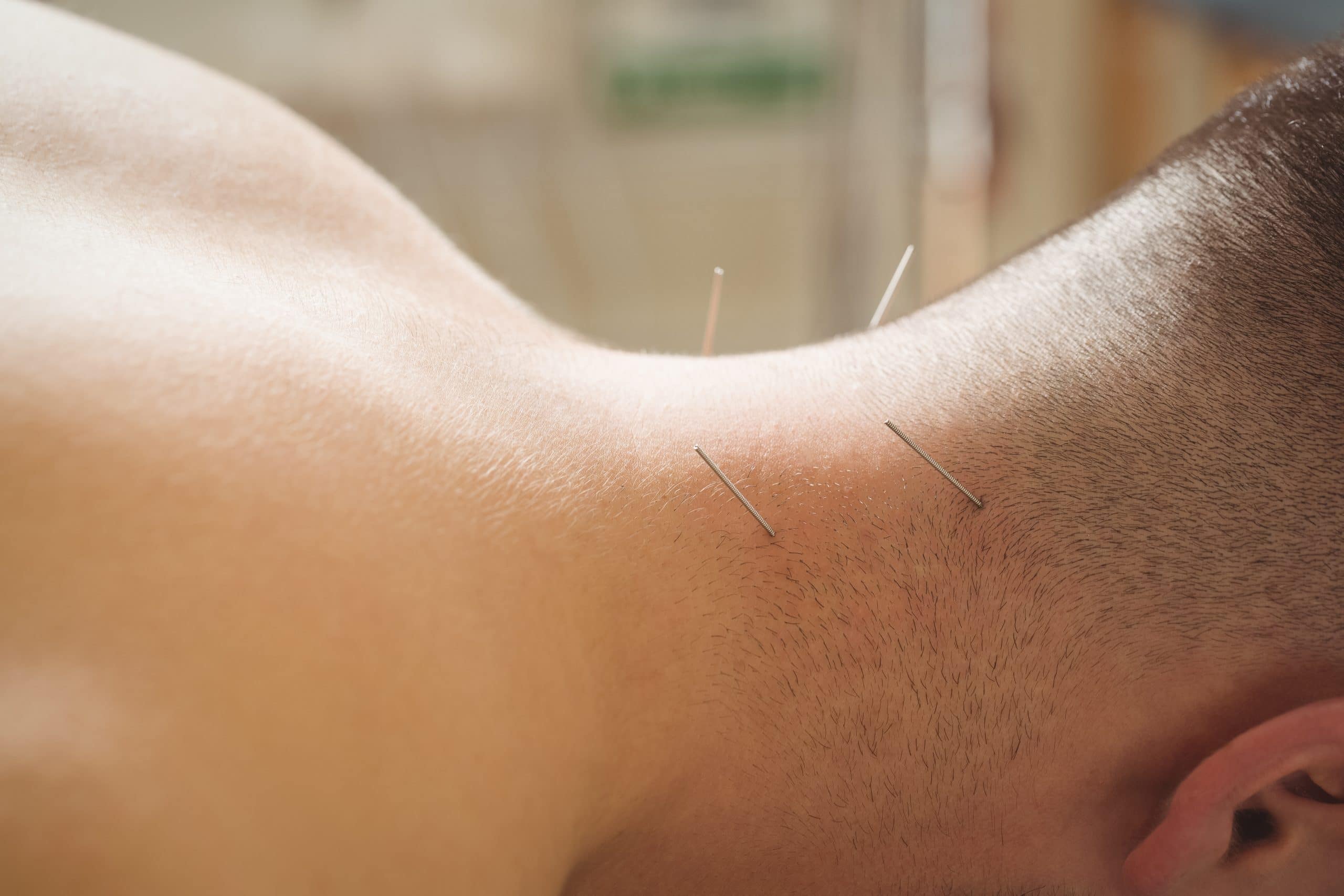 acupuncture